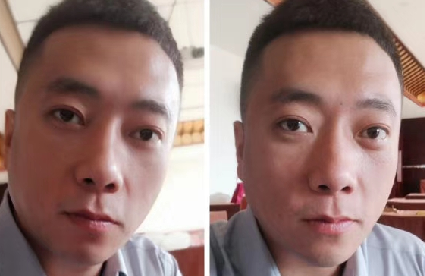去眼袋手术