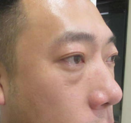 去眼袋手术