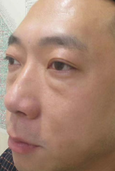 去眼袋手术