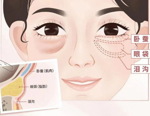 去眼袋手术