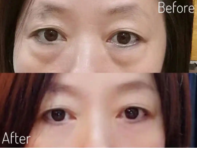 去眼袋手术