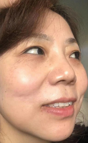 去眼袋手术
