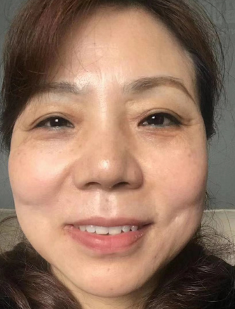 去眼袋手术