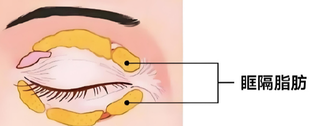 去眼袋手术