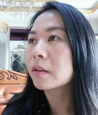 去眼袋手术