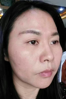 去眼袋手术