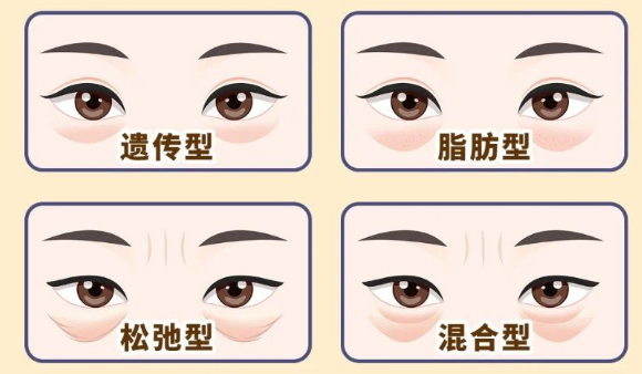 去眼袋手术