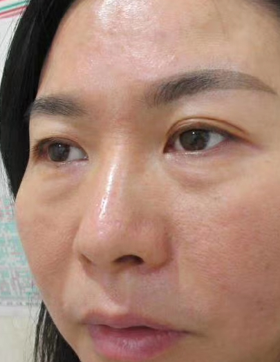 去眼袋手术