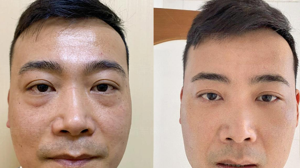 去眼袋手术