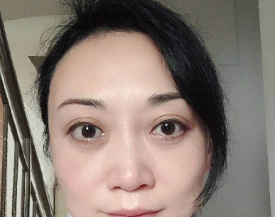 去眼袋手术