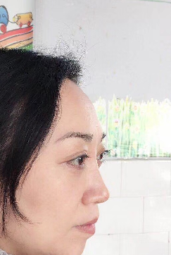去眼袋手术