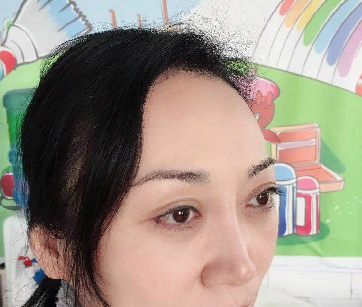 去眼袋手术