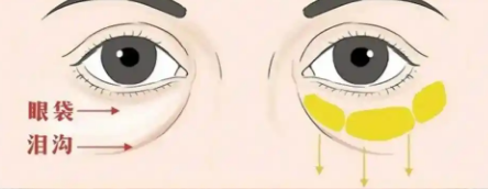 去眼袋手术