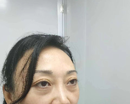 去眼袋手术