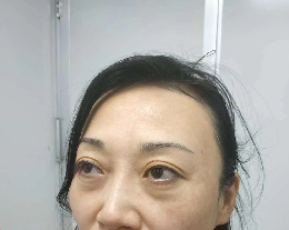 去眼袋手术