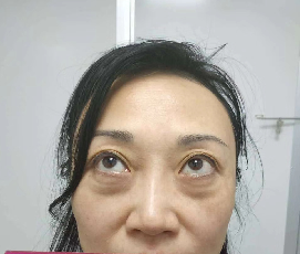 去眼袋手术