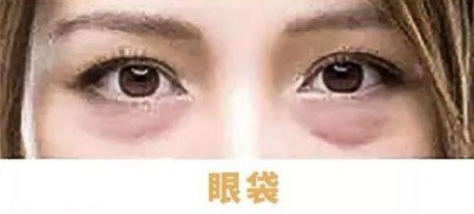 去眼袋手术