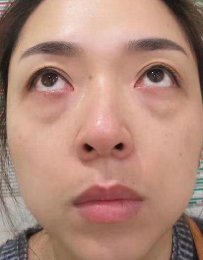 去眼袋手术