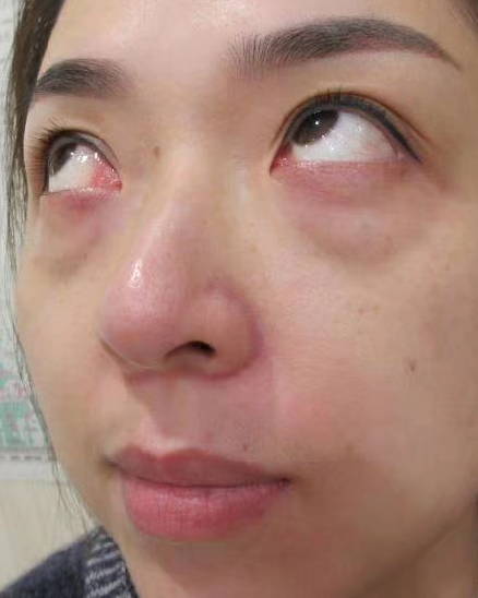 去眼袋手术