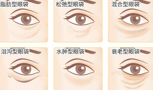 去眼袋手术
