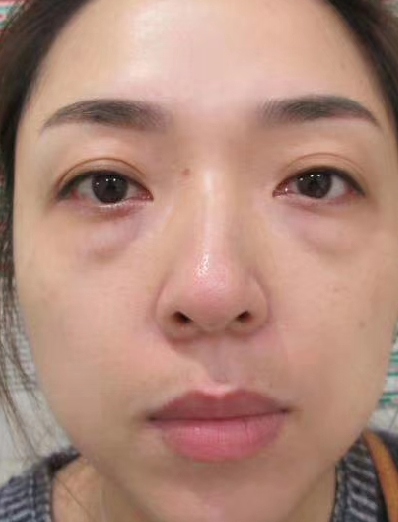 去眼袋手术