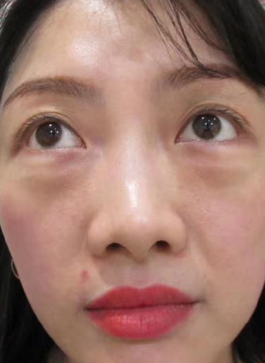 去眼袋手术