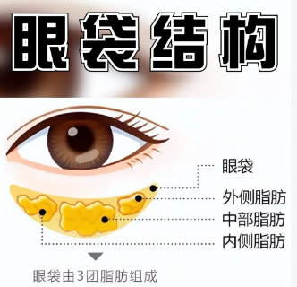 去眼袋手术