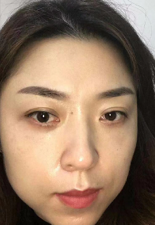 去眼袋手术