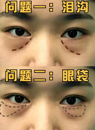 去眼袋手术