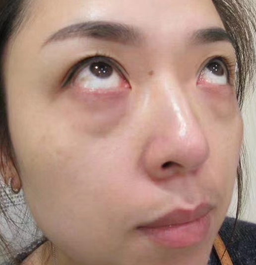 去眼袋手术