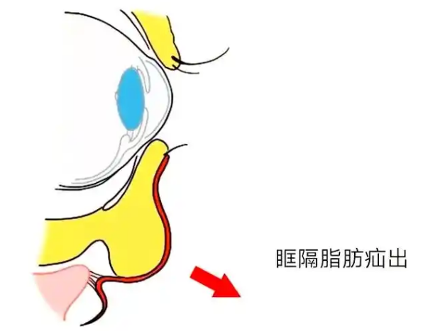 去眼袋手术