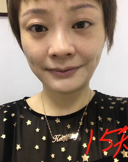 去眼袋手术