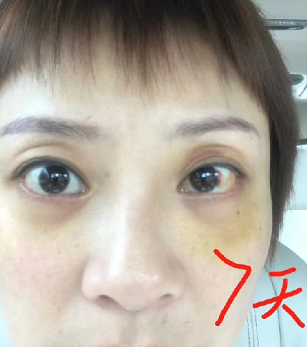 去眼袋手术