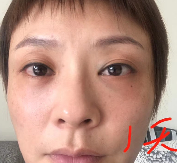 去眼袋手术