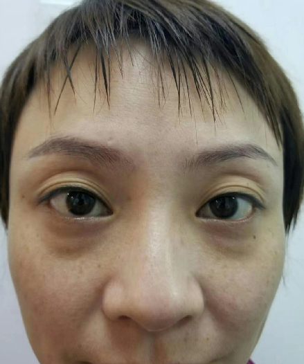 去眼袋手术