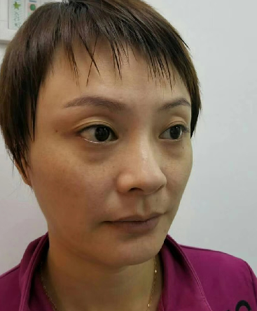 去眼袋手术