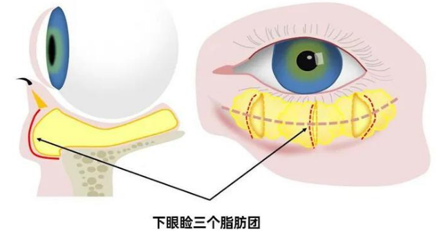 去眼袋手术