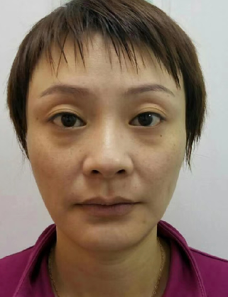 去眼袋手术