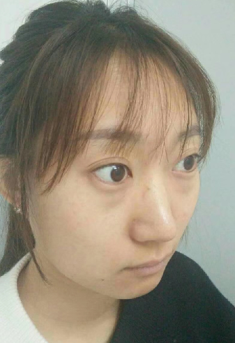 去眼袋手术