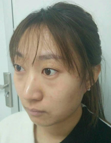 去眼袋手术