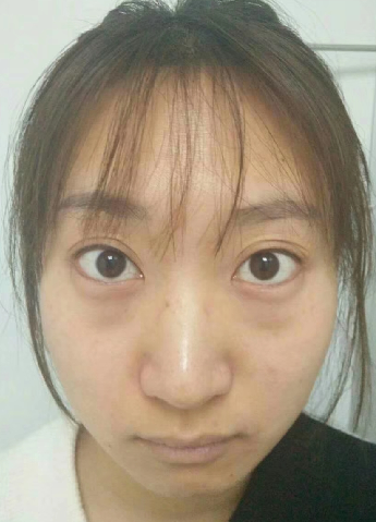 去眼袋手术
