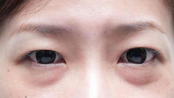 眼袋