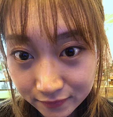 去眼袋手术