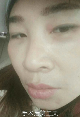 去眼袋手术