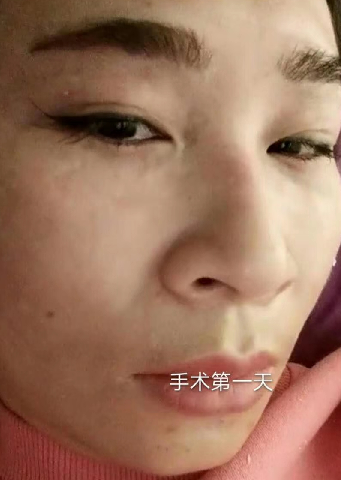 去眼袋手术