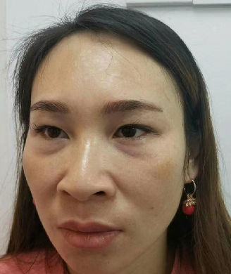 去眼袋手术