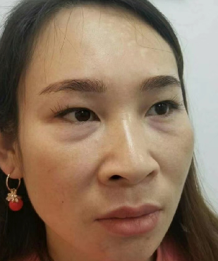 去眼袋手术