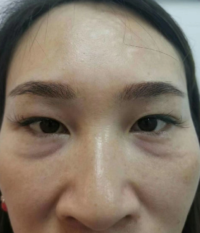 去眼袋手术