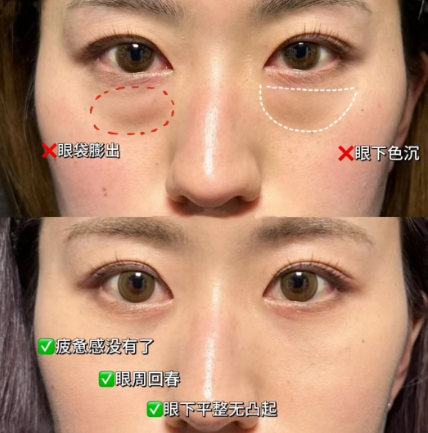 去眼袋手术