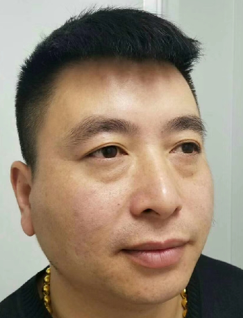 去眼袋手术